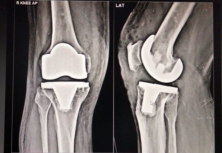 Joint Replacement